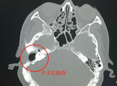 小孩游泳怎么预防中耳炎,儿童游泳如何预防中耳炎