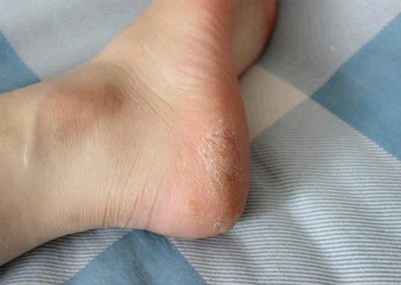 脚裂是身体哪个部位出问题了,脚四季都裂是什么原因