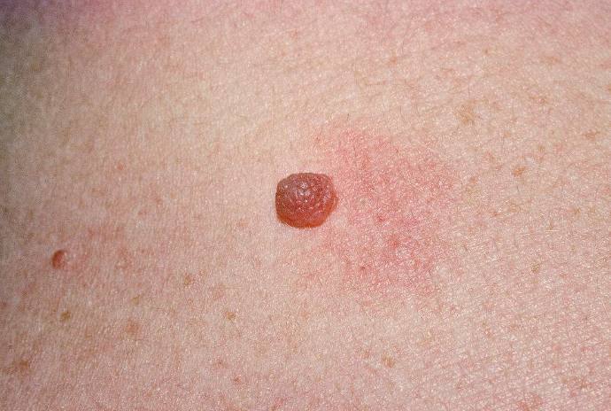 痣发红寓意,痣发红发痒怎么回事