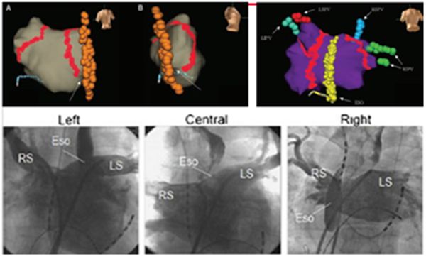 房颤力量训练,房颤的治疗讲座