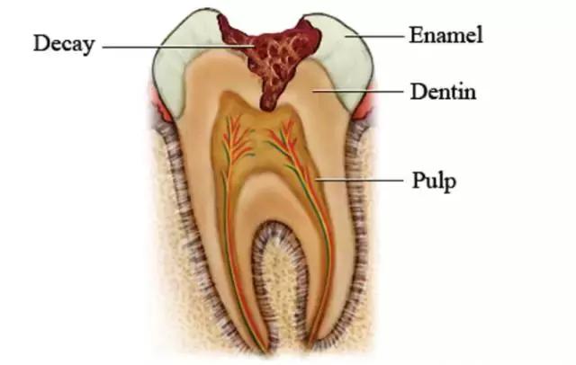 蛀牙痛了几天吃药也不见好怎么办,治疗一颗蛀牙很痛吗
