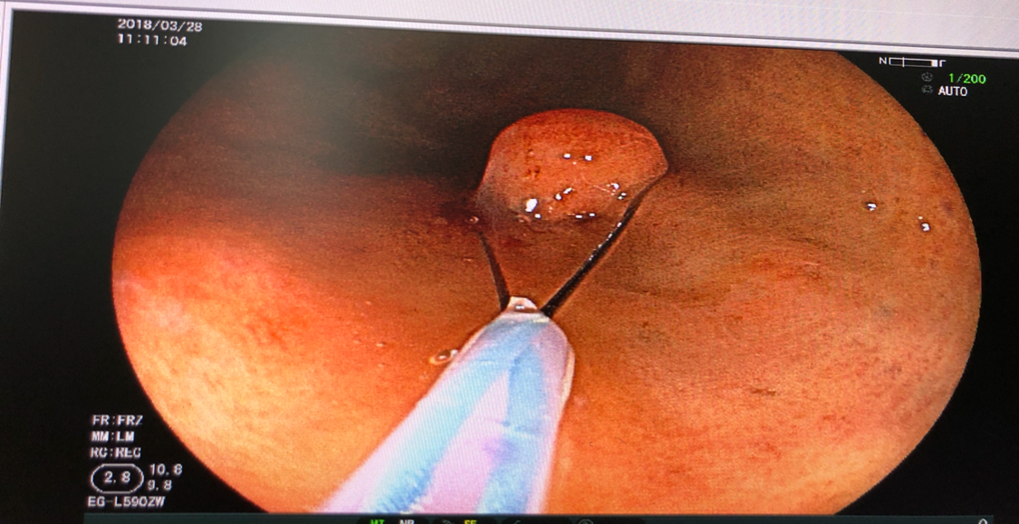 胃镜检查中发现息肉怎么处理,胃镜医生说发现胃肠息肉怎么办