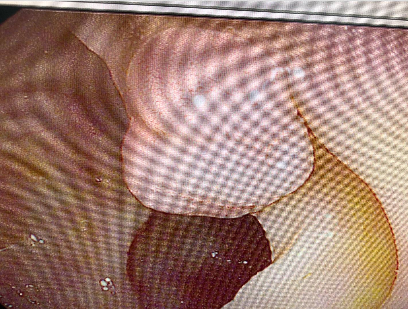 胃镜检查中发现息肉怎么处理,胃镜医生说发现胃肠息肉怎么办