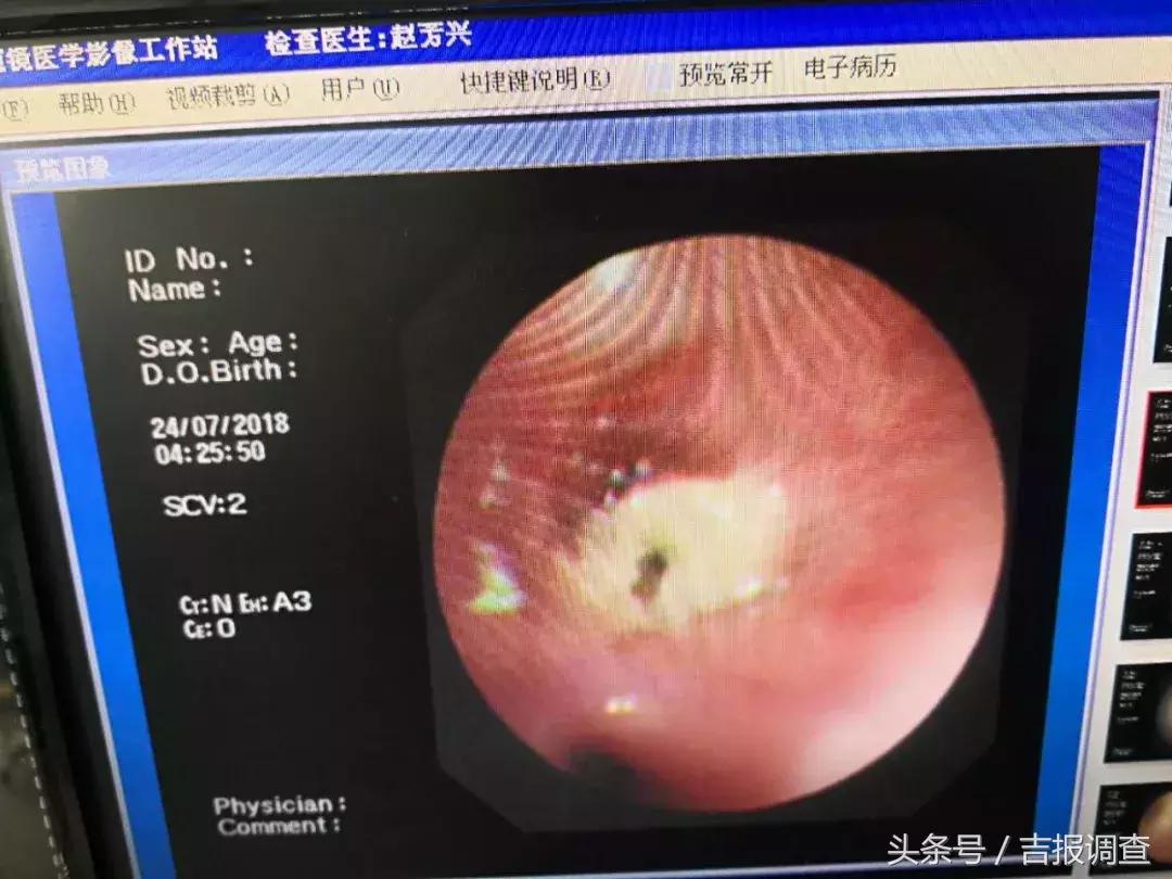 12个月小孩异物卡喉,孩子被鸡骨卡气管视频