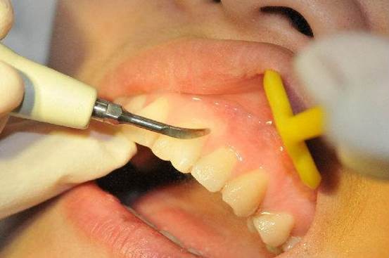 看牙太贵还不是因为你怕遭罪,不整牙有必要买冲牙器吗