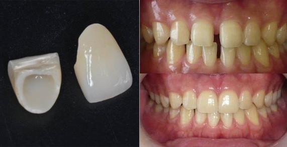 门牙牙缝大矫正最快的方法,门牙牙缝大怎么修复不伤牙齿