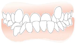 为什么有的人地包天那么不明显,为什么有一颗牙齿是地包天