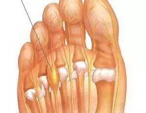脚趾长肿瘤,女子脚趾长肿瘤竟是穿鞋不当引发