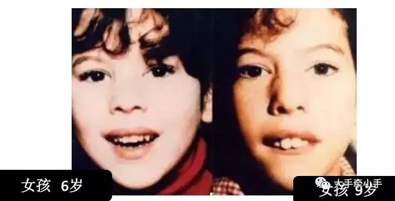 牙齿不齐矫正好还是做牙冠好,牙齿不齐矫正1个月的变化