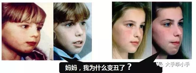 牙齿不齐矫正好还是做牙冠好,牙齿不齐矫正1个月的变化