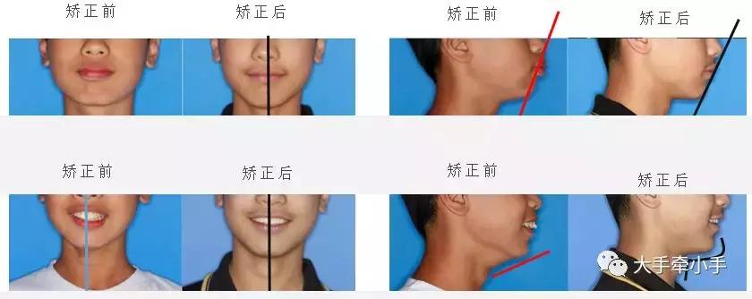 牙齿不齐矫正好还是做牙冠好,牙齿不齐矫正1个月的变化