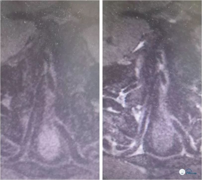 天坛周记｜左椎动脉开口及基底动脉串联狭窄血管内介入治疗1例