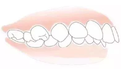 儿童换牙长歪了怎么及时矫正,孩子换牙期怎样注意可以换整齐