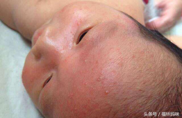 夏季如何避免宝宝长痱子,宝宝夏季出痱子怎么办