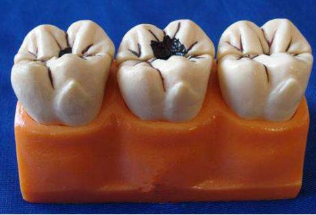 蛀牙是虫蛀的吗动画,蛀牙真的是虫蛀的嘛