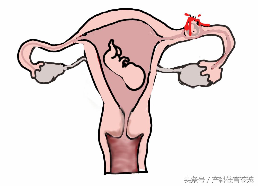 一个在宫内，一个在宫外，这种双胎有点麻烦