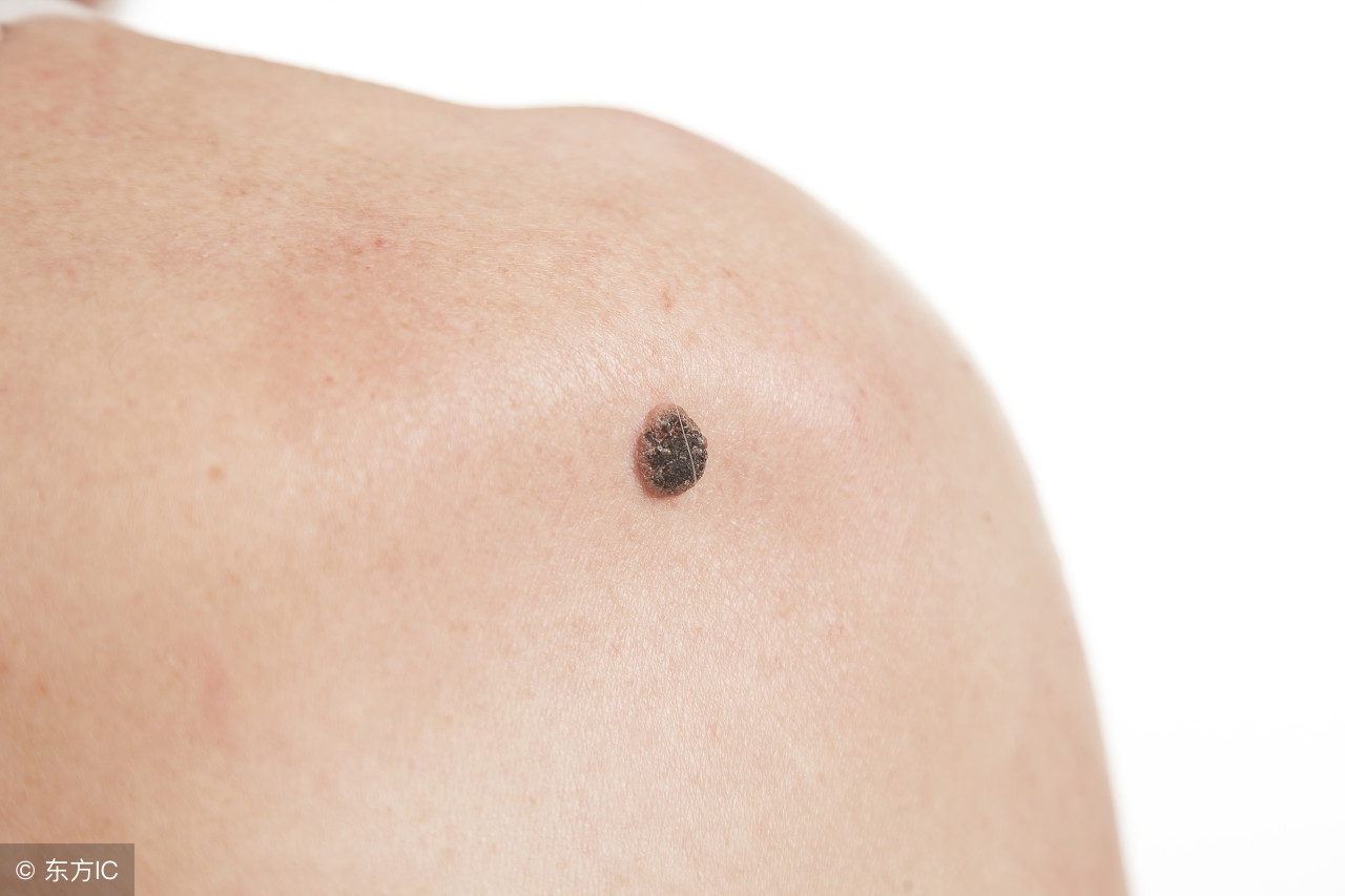 皮肤癌早期症状都有哪些,皮肤癌早期诊断早发现早治疗