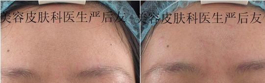 治疗毛孔粗大的护肤品,烟酰胺可以治疗毛孔粗大吗