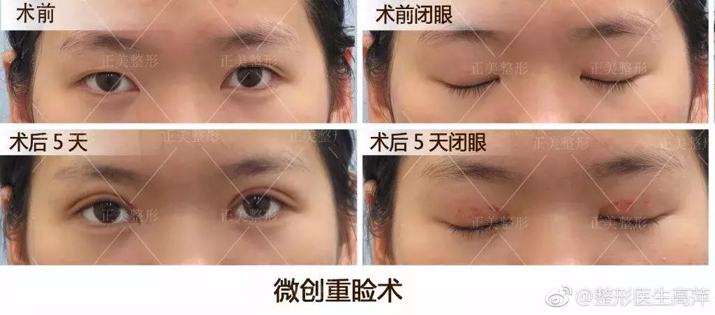 双眼皮刚割完不对称后来好了,全切双眼皮拆线后不对称