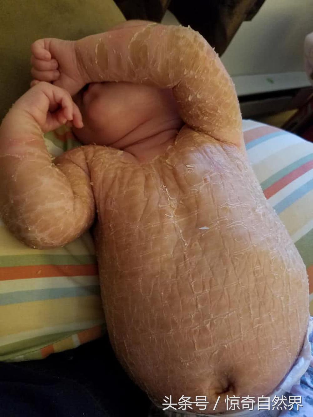 婴儿鱼鳞病出生就有吗,婴儿鱼鳞病多久会死