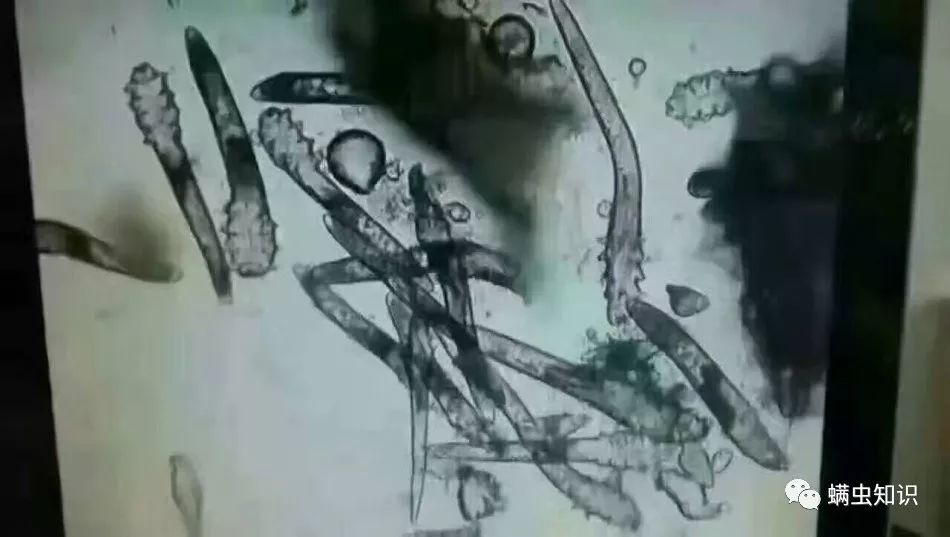 换季脸上长痘,换季脸上长痘痒怎么办