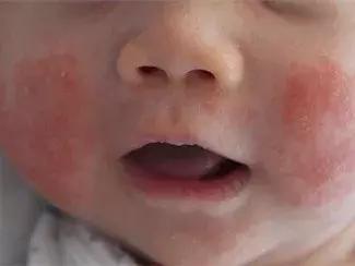 宝宝长小疹子后溃烂,宝宝的红疹子溃烂了