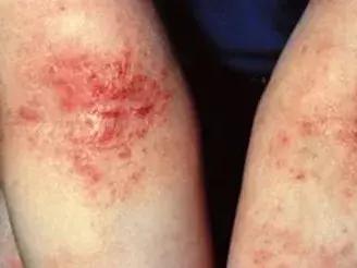 宝宝长小疹子后溃烂,宝宝的红疹子溃烂了