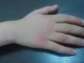 宝宝长小疹子后溃烂,宝宝的红疹子溃烂了