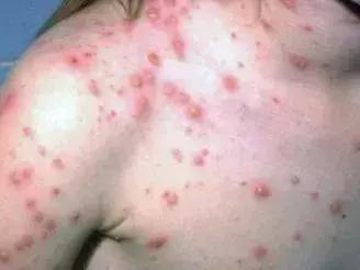 宝宝身上一大片的包是怎么回事,宝宝身上好多片包