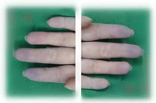 健康的手掌是什么颜色,看手掌鱼际颜色知健康