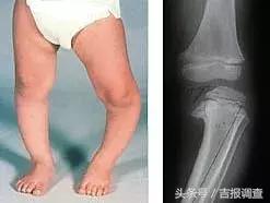 婴儿缺钙腿会长不直吗,婴儿腿不直怎么治最有效