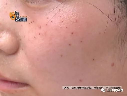 杭州点痣女生,去医院取痣花了1000多元