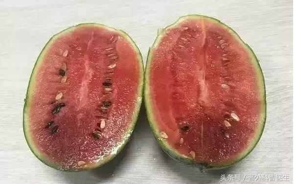 吃西瓜导致死亡是真的吗,吃西瓜吃出人命