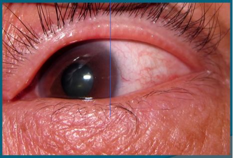 角膜上皮细胞损伤多久能恢复,治疗角膜上皮细胞损伤全国专家