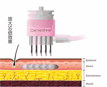 有人劝你打玻尿酸,打玻尿酸的一些常识问题