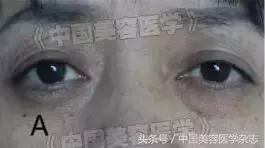 外眦韧带固定是什么手术,外眦悬吊固定疤痕多久恢复