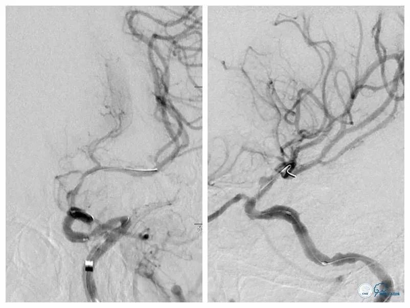 颈内动脉c5到c7段狭窄微创手术,天坛医院住院日记