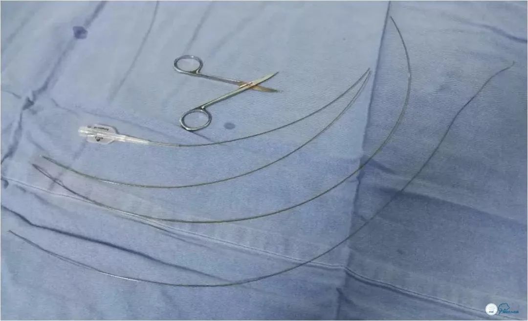 颈内动脉c5到c7段狭窄微创手术,天坛医院住院日记