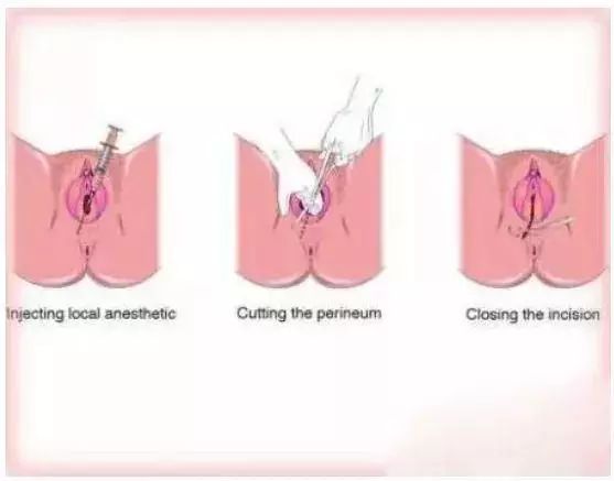 顺产如何才能不被侧切,顺产侧切无撕裂技巧