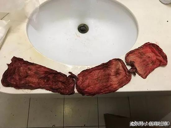 剖腹产后产妇怎么出来,产妇剖腹产第几天有奶