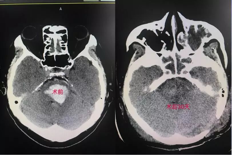 「技术硬实力」不断创新发展的玉田县中医医院脑病四科！