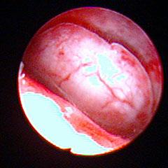 妇科专家讲解视频大全,妇科宫腔镜是怎么检查的