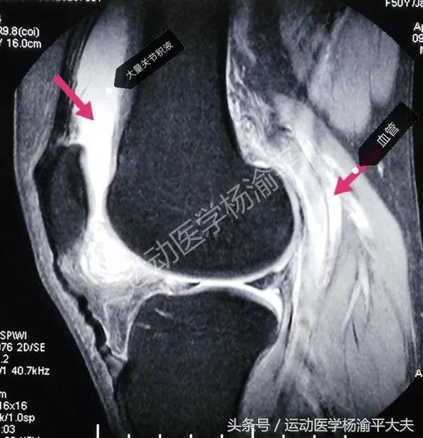 关节滑膜炎加关节积液怎么办,关节间隙积液和关节腔积液的区别