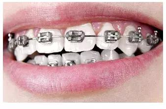 最近比较火的牙套妹教你拍照,牙套妹怎么拍艺术照好看