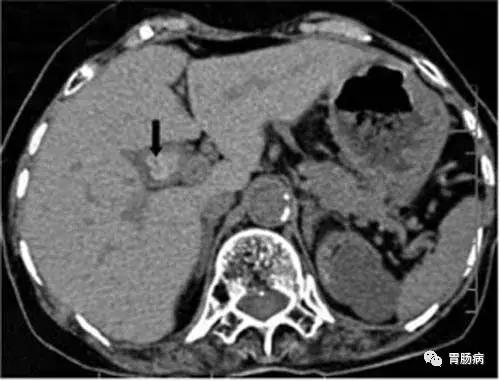 肠息肉切除还是不切除,肠息肉和胆囊息肉必须做手术吗