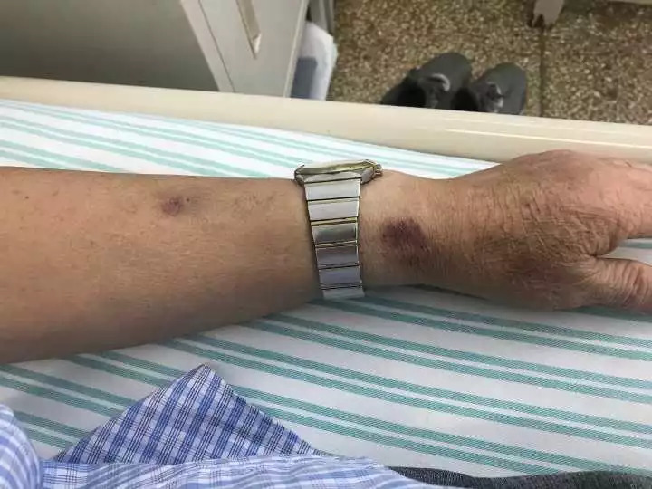 天呐！大伯吃掉上百支“皮炎平”软膏，医生一问都懵了