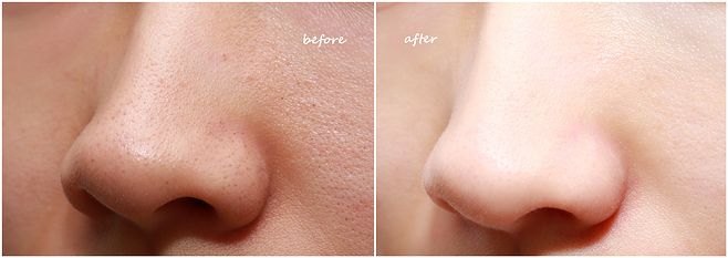 油皮泛红毛孔粗大医美,黑头毛孔粗大医美手段