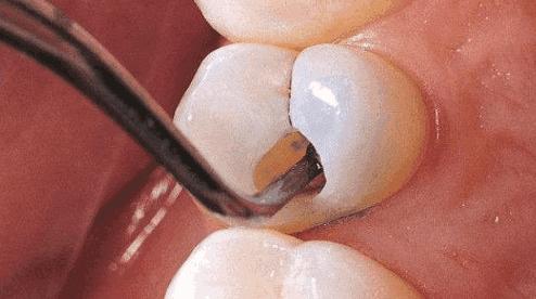 虫牙是虫子引起的吗,虫牙真的是被虫子吃掉的吗