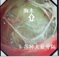 胸水为什么会抽不到,胸水抽了为什么还呼吸困难