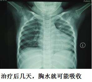 胸水为什么会抽不到,胸水抽了为什么还呼吸困难